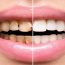 درمان پوسیدگی دندان در طب سنتی