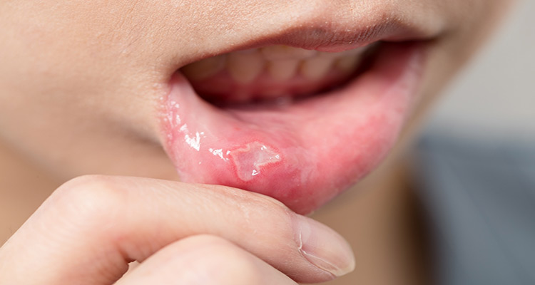 درمان آفت دهان با راهکارهای سنتی