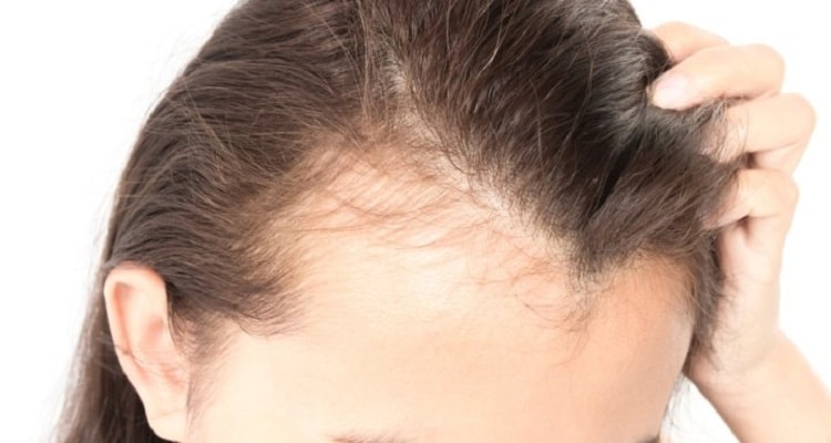 پیشگیری و درمان ریزش مو و کچلی در پزشکی جدید