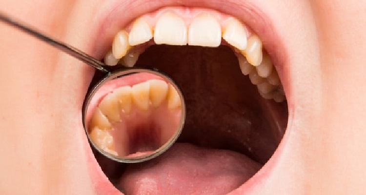 درمان پوسیدگی دندان در طب جدید