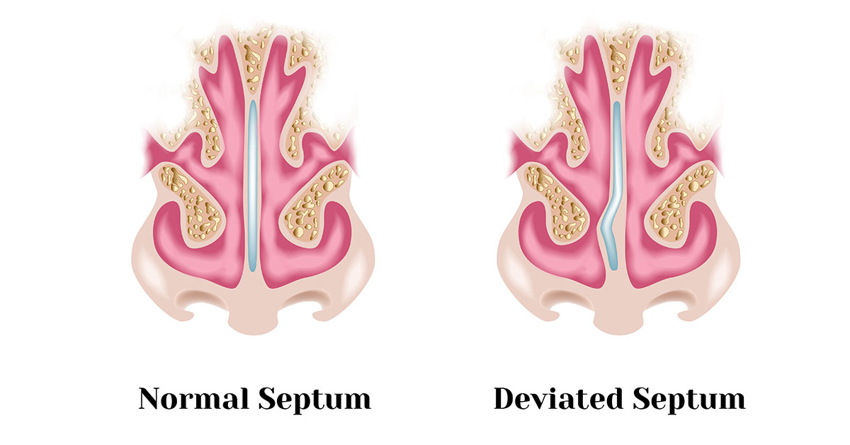 درمان عوارض ناشی از انحراف بینی در طب سنتی 1 انحراف بینی