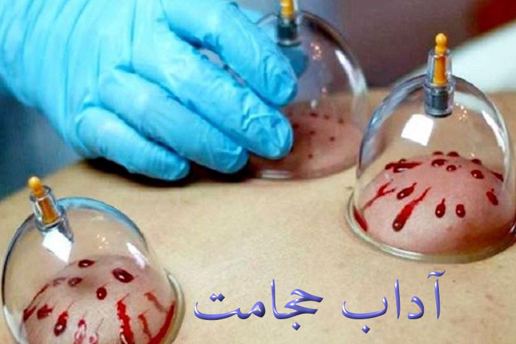 آداب حجامت در طب سنتی