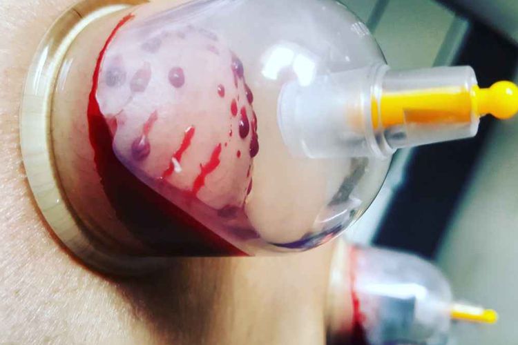 35 فایده حجامت برای اطفال، کودکان و نوجوانان