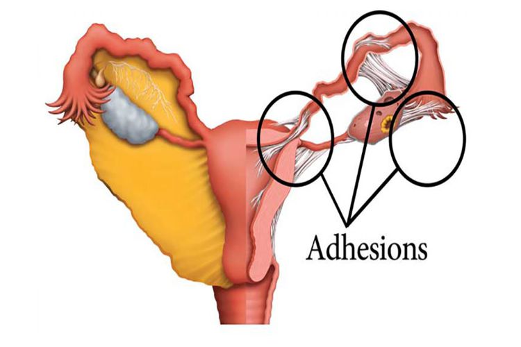 درمان چسبندگی رحم به کمک طب سنتی