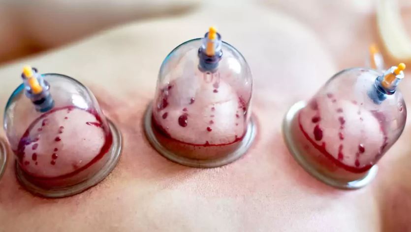 حجامت تر و حجامت عام یا نافع در طب سنتی