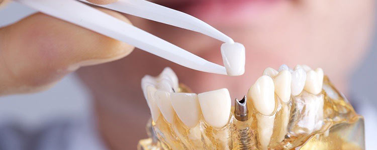 طول عمر ایمپلنت دندان چقدر است و چگونه میتوان آن را افزایش داد؟ 1 ایمپلنت