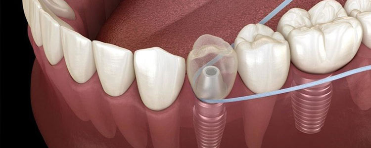 طول عمر ایمپلنت دندان چقدر است و چگونه میتوان آن را افزایش داد؟ 2 ایمپلنت