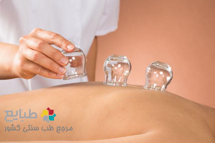 حجامت خشک و انواع آن در طب سنتی