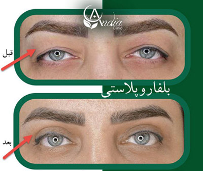 راحت ترین راه برای از بین بردن پف اطراف چشم 1 پف چشم