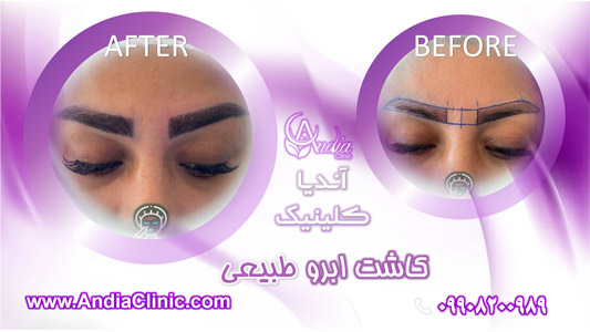 راحت ترین راه برای از بین بردن پف اطراف چشم 2 کاشت ابرو