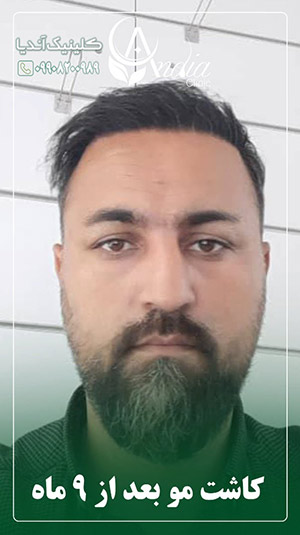 راحت ترین راه برای از بین بردن پف اطراف چشم 3 کاشت مو