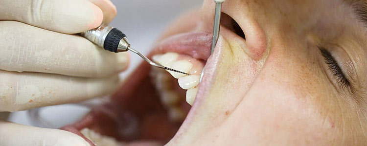 جوش چرکی بدون درد روی لثه نشانه چیست؟ 9 درمان خانگی جوش لثه 1 درمان جوش چرکی