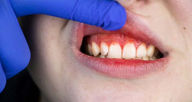 جوش چرکی بدون درد روی لثه نشانه چیست؟ 9 درمان خانگی جوش لثه