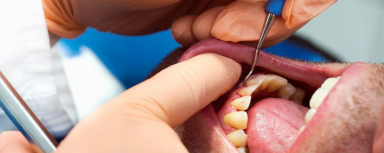 جوش چرکی بدون درد روی لثه نشانه چیست؟ 9 درمان خانگی جوش لثه 2 درمان جوش چرکی