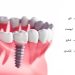 ایمپلنت دیجیتال دندان