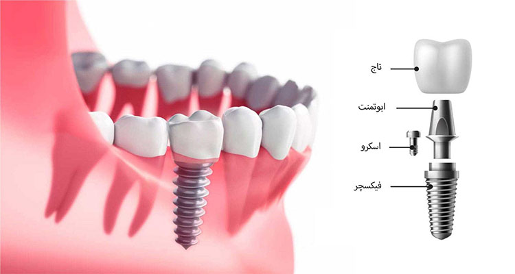 ایمپلنت دیجیتال دندان
