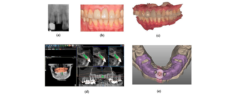 ایمپلنت دیجیتال دندان 