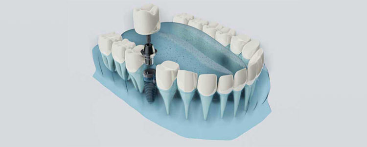 ایمپلنت دیجیتال دندان 