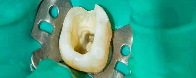 عصب‌کشی دندان