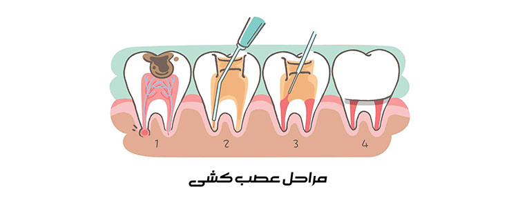 عصب‌کشی دندان