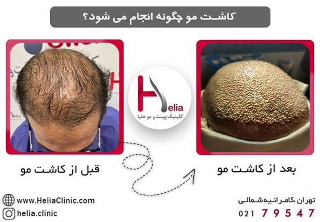 کاشت مو: موهای خود را به حالت اولیه برگردانید!