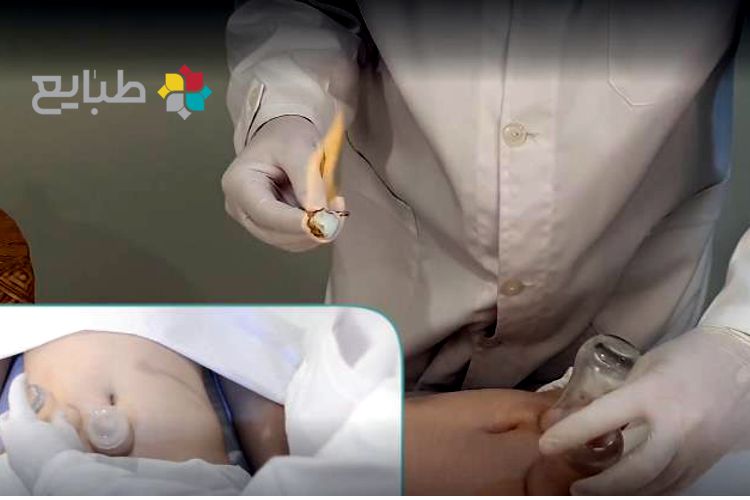 آموزش ساده بادکش رحم و تخمدان ها در منزل