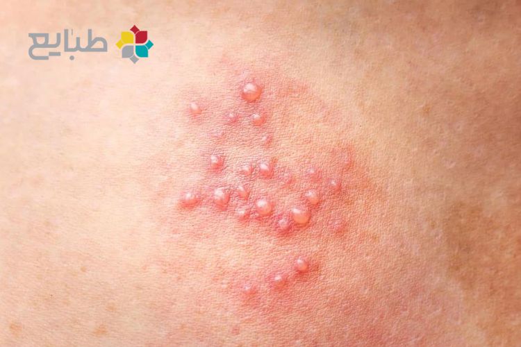 تبخال تناسلی و تفاوت آن با زگیل تناسلی