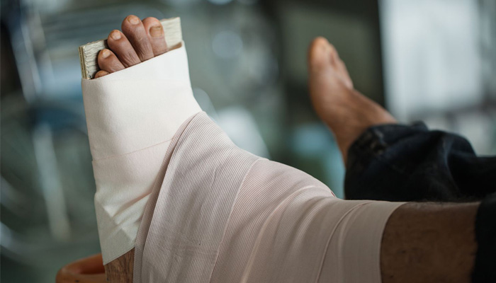 تعویض مفصل مچ پا (آرتروپلاستی مچ پا): هر آنچه باید بدانید 2 آرتروپلاستی