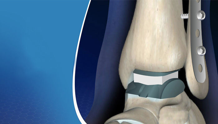 تعویض مفصل مچ پا (آرتروپلاستی مچ پا): هر آنچه باید بدانید