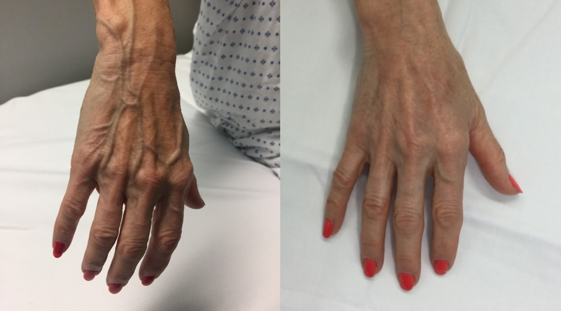 C:UsersdiamondDesktopVaricose veins on the hand ..png