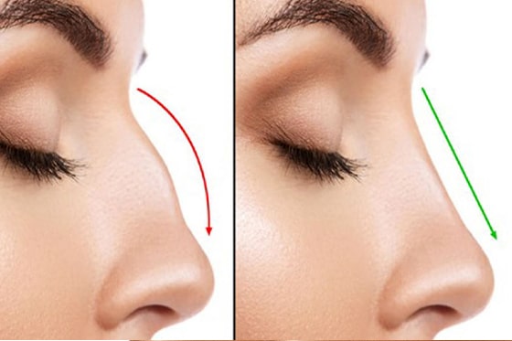 تیپ پلاستی بینی