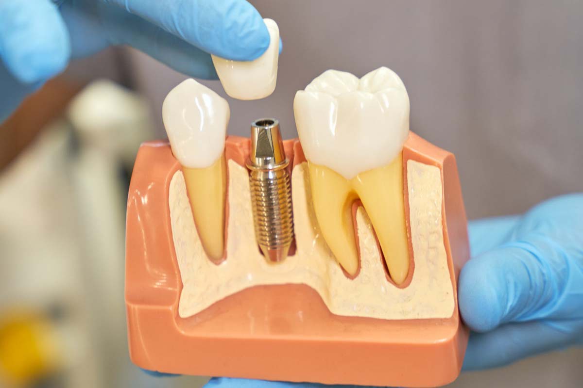 برای ایمپلنت به چه دکتری مراجعه کنیم؟