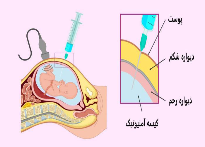 آمنیوسنتز