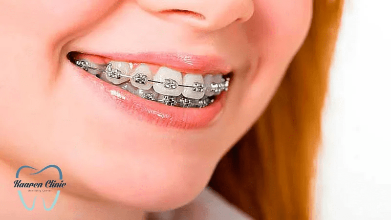 انواع ارتودنسی دندان که میتوانند نظم را به دندانها باز گرداند 2 ارتودنسی