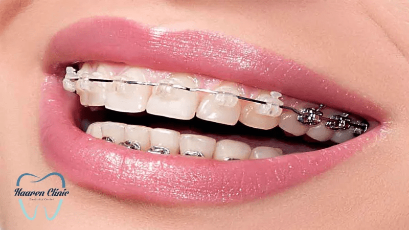 انواع ارتودنسی دندان که میتوانند نظم را به دندانها باز گرداند 1 ارتودنسی