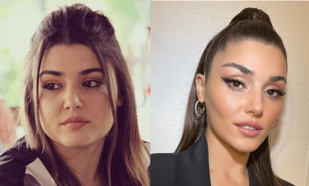 عمل زیبایی هانده ارچل | تغییرات زیبایی قبل و بعد از عمل