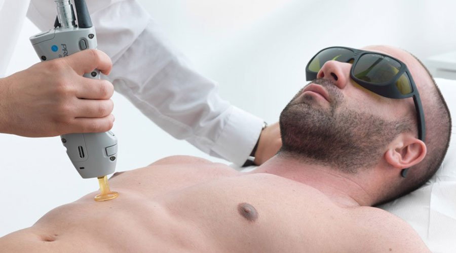 لیزر موهای زائد