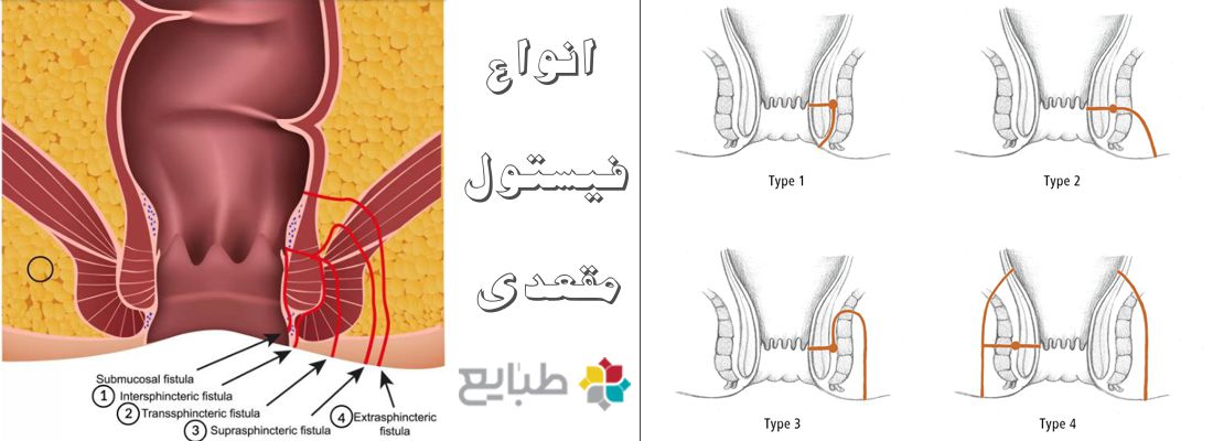 درمان فیستول مقعدی در طب سنتی و طب نوین 1 انواع فیستول