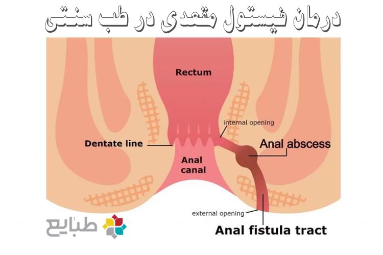 درمان فیستول مقعدی در طب سنتی و طب نوین