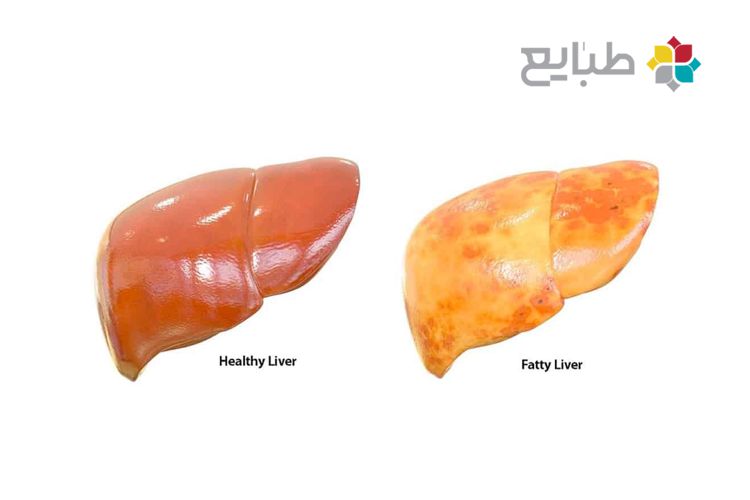 ۱۹ ماده طبیعی برای درمان کبد چرب