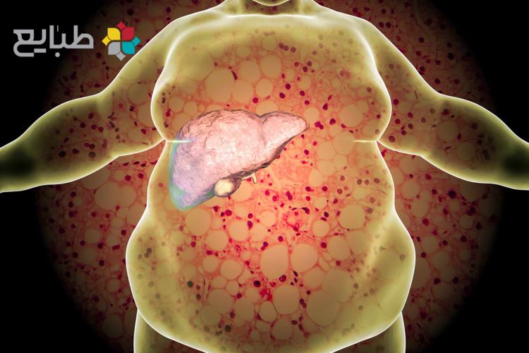 رفع کبد چرب با درمان گیاهی