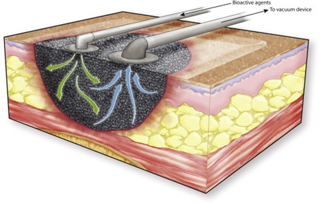 تکنیک وکیوم تراپی زخم چیست ؟