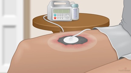 وکیوم تراپی