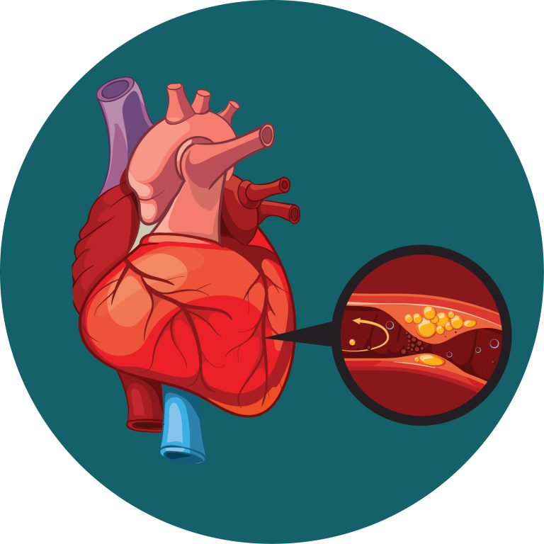 بیماری های قلب و عروق 7 سکته قلبی