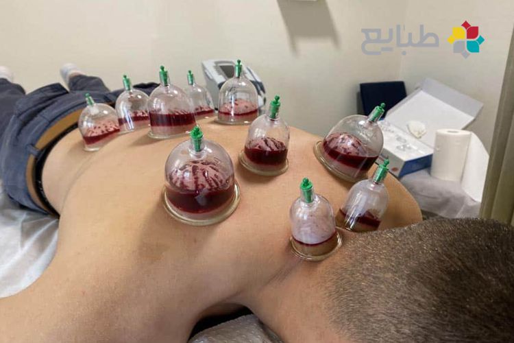 نکات قبل و بعد از خونگیری (حجامت، فصد یا زالو درمانی)