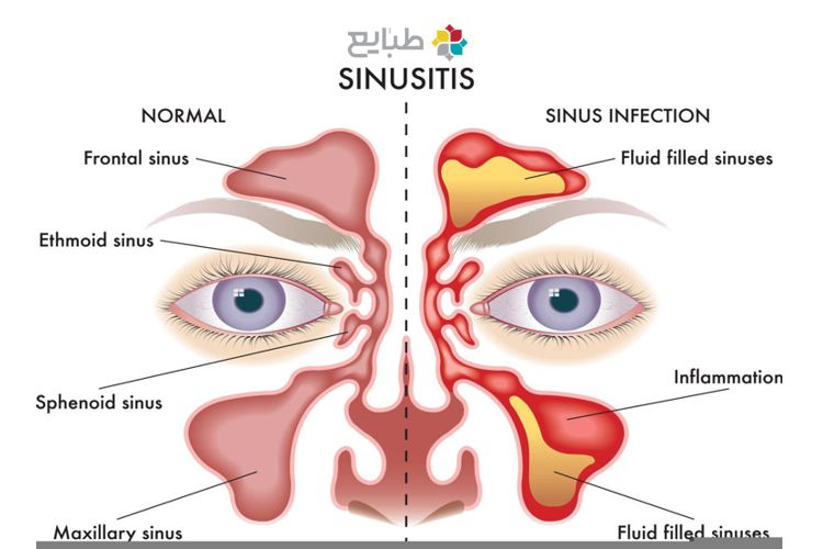 درمان سینوزیت و عفونت چشم
