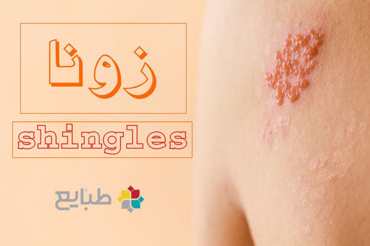 زونا در طب سنتی