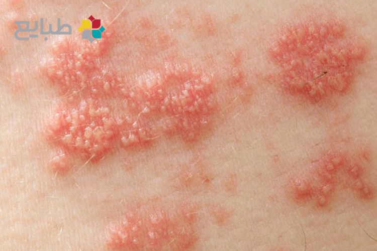 درمان کیست و تبخال تناسلی با طب سنتی