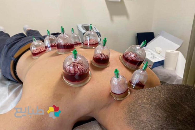 تقویم حجامت چیست؟